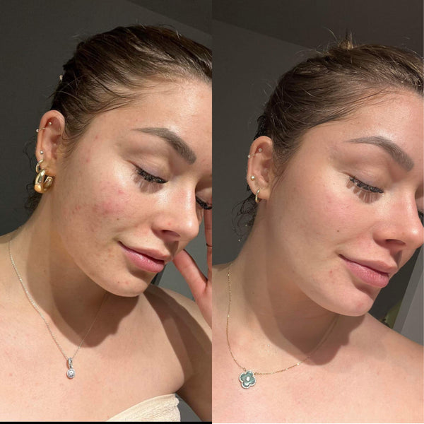 Peeling chimique